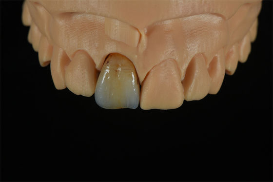 Kalite  Affordable Zirconia Crowns with Custom Color Staining - China Dental Lab Fabrika